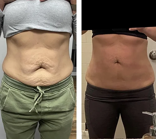 Makeover Treatment Snellville GA Before and After1 Makeover Treatment Snellville GA Before and After1