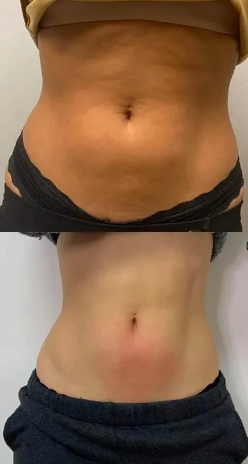 Makeover Treatment Snellville GA Before and After2 Makeover Treatment Snellville GA Before and After2