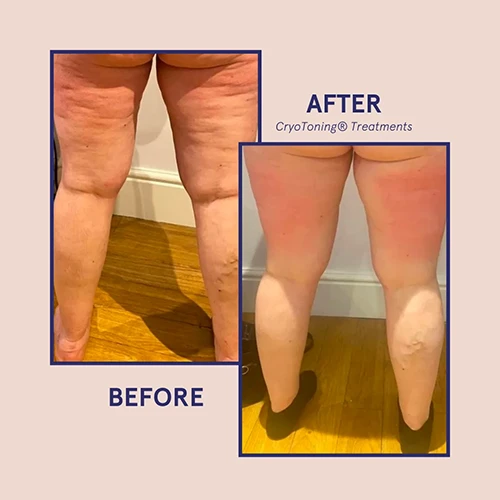 Makeover Treatment Snellville GA Before and After4 Makeover Treatment Snellville GA Before and After4