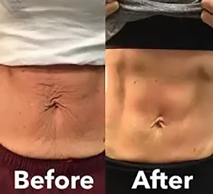 Makeover Treatment Snellville GA Before and After6 Makeover Treatment Snellville GA Before and After6